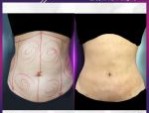 Hút mỡ bụng Thai Hi Lipo – Bí quyết sở hữu vòng 2 thon gọn, cuốn hút