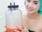 Lưu ý quan trọng hút mỡ sát tết nhanh hồi phục
