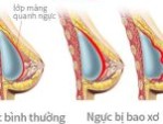 Nâng ngực bị bao xơ – Dấu hiệu và cách trị mà bạn nên biết