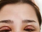 Cắt mí 1 tháng vẫn sưng: Nguyên nhân, cách khắc phục