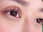 Cắt mí 20 ngày vẫn sưng? – Bí quyết ngăn ngừa mắt sưng