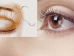 Cắt mí bao lâu thì cắt chỉ – Chăm sóc đúng cách sau cắt mí