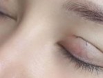 Cắt mí sau 5 ngày sưng không – 5 Lưu ý giúp mắt đẹp quyến rũ