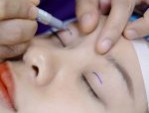 Cắt mí sưng bao lâu – Các lưu ý giúp mí nhanh hồi phục