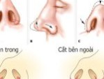 Có nên đi cắt cánh mũi không? – Lời khuyên từ chuyên gia