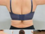 Hút mỡ vai có tốt không- Hướng dẫn chăm sóc đúng cách