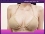 Nâng ngực mất bao nhiêu thời gian- Bác sĩ Robert Nguyễn giải đáp