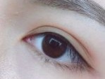 Cắt mí bao lâu thì phun mí được – Yếu tố ảnh hưởng thời gian