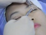 Cắt mí mắt có để lại sẹo không? 6 Cách phòng tránh sẹo hiệu quả