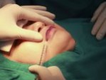 Cắt môi trái tim giữ được bao lâu? 4 Yếu tố quan trọng