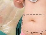 Tạo hình thành bụng giá bao nhiêu? Cập nhật bảng giá mới