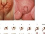Tình trạng lưỡng giới giả nữ và thông tin cần nắm rõ