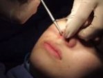 Cắt cánh mũi xong bị chảy máu kéo dài – Lưu ý cần biết