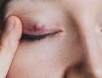 Bảo vệ mắt: 3 dấu hiệu nhiễm trùng nhấn mí – Thống kê mới