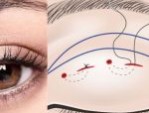 Nhấn mí sau bao lâu thì tiêu chỉ? Những yếu tố ảnh hưởng