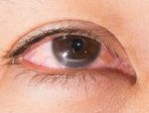 10 cách khắc phục tình trạng mí mắt bị sưng sau khi ngủ dậy