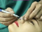 Cắt cánh mũi có để lại sẹo không – Những lưu ý tránh sẹo