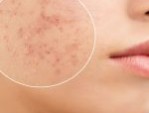 Bí  kíp trị thâm mụn cấp tốc sau 1 đêm đã được kiểm chứng