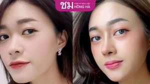 8 Kỹ thuật nâng mũi đẹp tự nhiên, thành công đến 90%