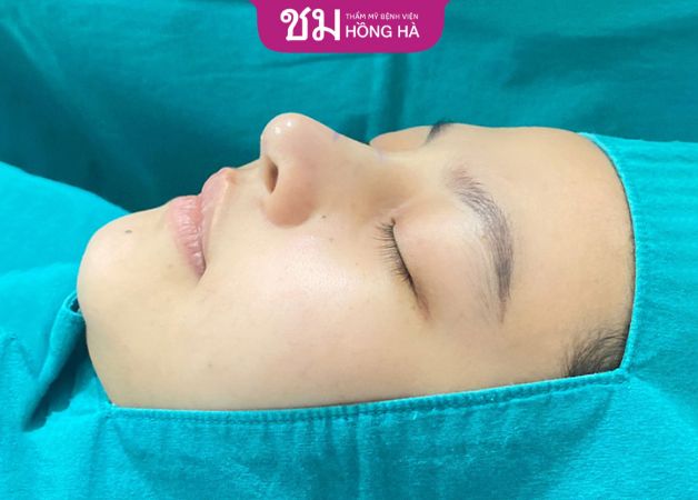 Khách hàng nâng mũi đẹp tự nhiên tại Thẩm mỹ Bệnh viện Hồng Hà