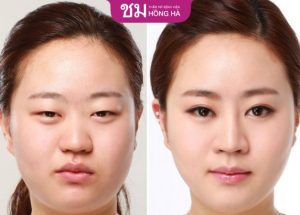 Treo cơ mi – Phương pháp điều trị sụp mí, lão hóa vùng mắt hiệu quả nhất