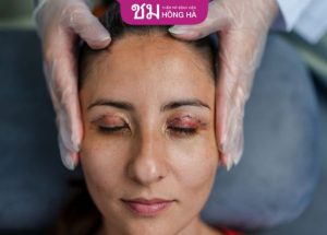 Chỉnh sửa biến chứng sau thẩm mỹ mắt hoàn thiện vẻ đẹp đôi mắt