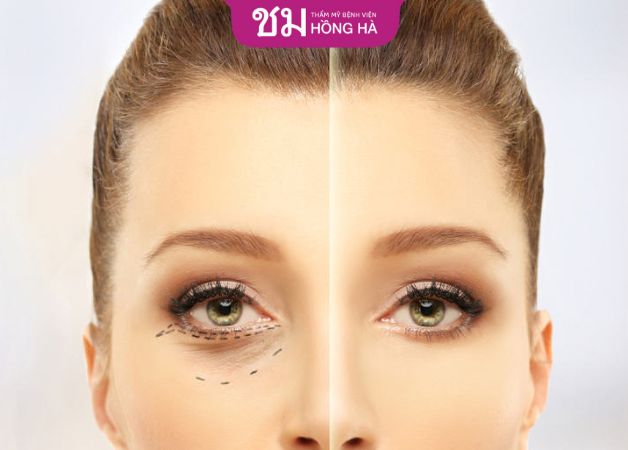 Cấy mỡ tự thân vùng mắt không gây nguy hiểm cho khách hàng
