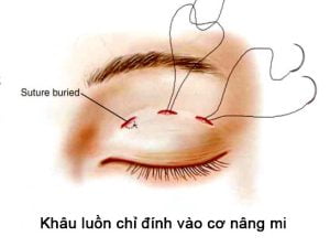 Khâu tạo mắt 2 mí : Mắt đẹp tự nhiên, không cần phẫu thuật