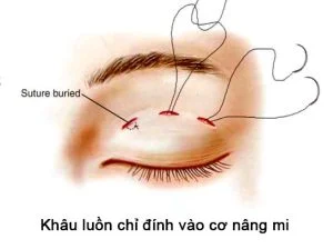 Khâu tạo mắt 2 mí : Mắt đẹp tự nhiên, không cần phẫu thuật