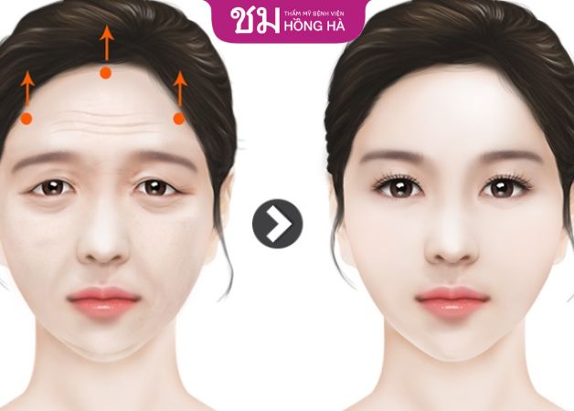 Quy trình nâng chân mày chuẩn y khoa