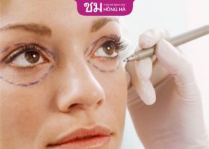 Phẫu thuật thừa da mí mắt – Khắc phục chảy xệ, mắt đẹp tự nhiên