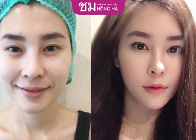 Không đau, thời gian nghỉ dưỡng ngắn