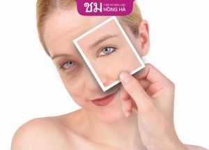 Phẫu thuật lấy bọng mắt – Lấy lại đôi mắt to tròn sau 30 phút