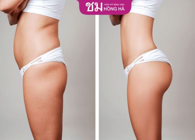 Thấy rõ sự khác biệt giữa hình ảnh trước và sau khi cấy mỡ mông