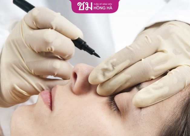 Phương pháp chỉnh sửa mũi bị hỏng sau nâng tại Thẩm mỹ Bệnh viện Hồng Hà