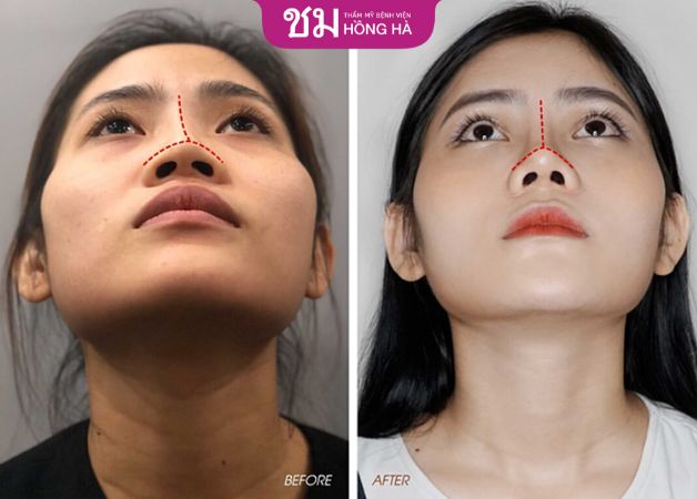 Chị Hoa bị lệch mũi đã được cải thiện sau khi nâng mũi siêu cấu trúc tại Hồng Hà