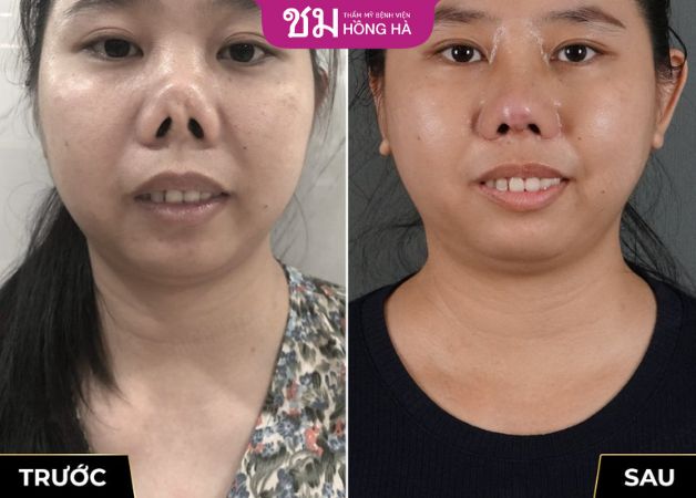 Khách hàng thành công chỉnh sửa lại mũi hỏng