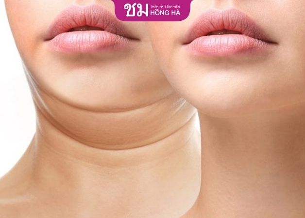 Hút mỡ nọng cằm không nguy hiểm