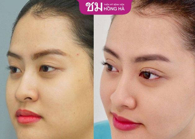 Gương mặt trở nên thon gọn hơn sau khi hút mỡ vùng má
