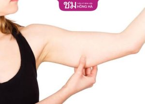 Hút mỡ vùng cánh tay loại bỏ 99% mỡ thừa, hiệu quả dài lâu