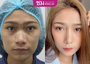 Nâng mũi bằng sụn tự thân: Không đau – Đẹp vĩnh viễn