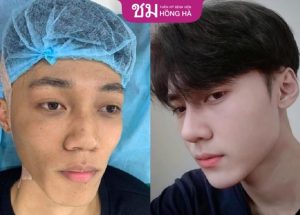 Nâng mũi đàn ông đẹp: Khắc phục 6 khuyết điểm mũi thường gặp