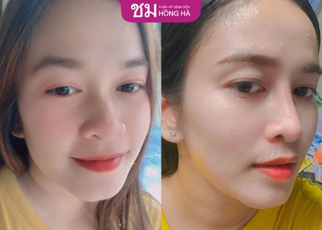 Dáng mũi to bè trở nên thẳng tắp và thon gọn hơn khi nâng mũi tại Hồng Hà