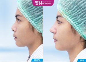 Nâng mũi kết hợp chất liệu tự thân đẹp, thẳng tự nhiên