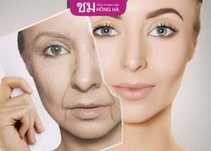 Phẫu thuật căng da mặt toàn phần – Lưu Giữ Nét Đẹp Tuổi Xuân