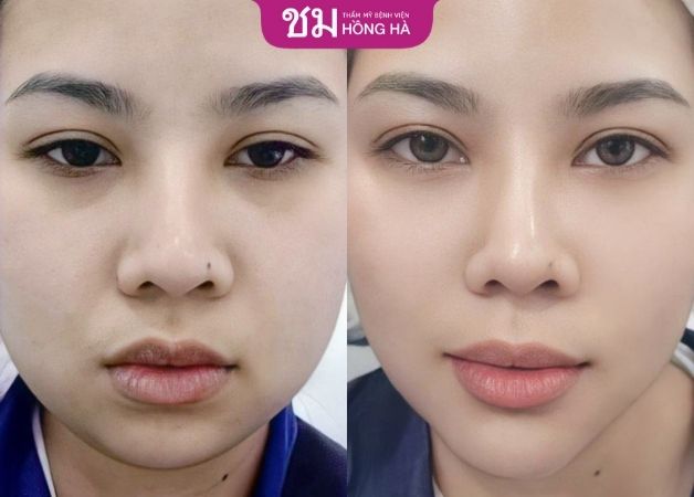 Dáng cằm to của chị khách hàng trở nên thon gọn hơn
