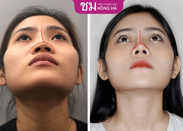 Khách hàng tự tin khi sở hữu chiếc mũi đẹp, thẳng