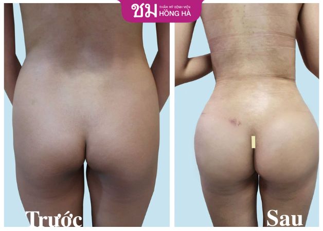 Lột xác vòng 3 lép xẹp thành chiếc mông căng tròn