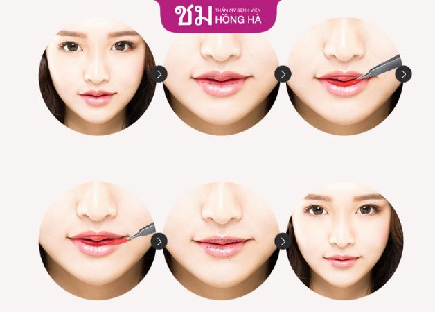 Quy trình thẩm mỹ tạo hình môi
