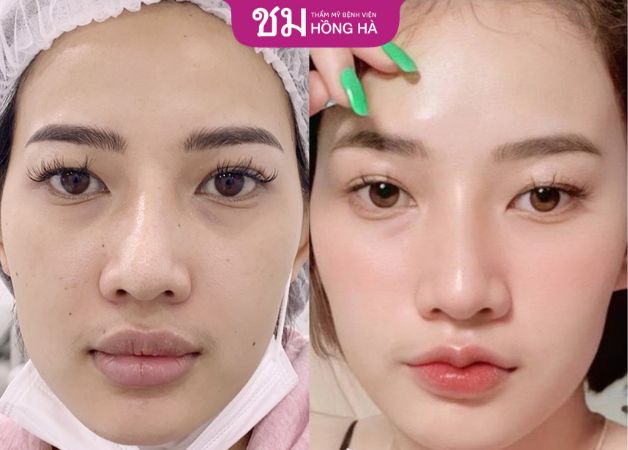 Cải thiện đôi môi dày thành dáng môi trái tim mềm mại